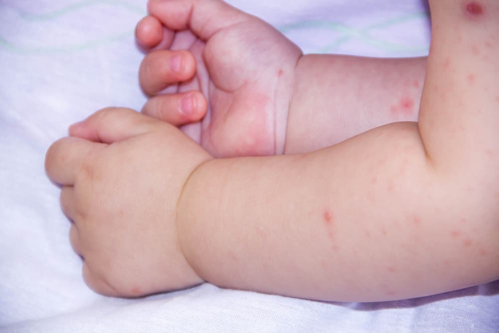 Πώς μπορούμε να προστατεύσουμε τα μωρά από τα κουνούπια; 