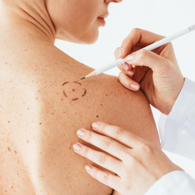 Ποιοι ιοί ευθύνονται για καρκίνο του δέρματος;